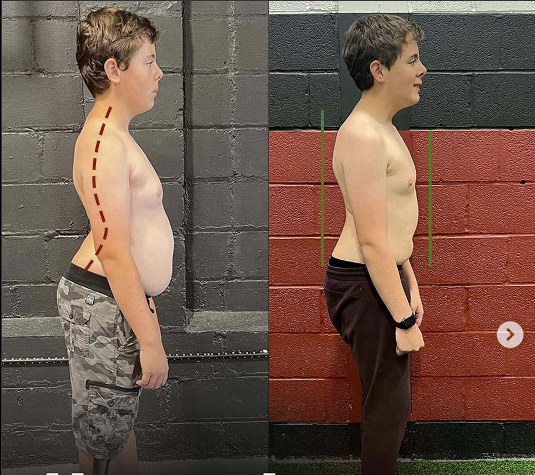 Understanding hypermobility syndrome in autism