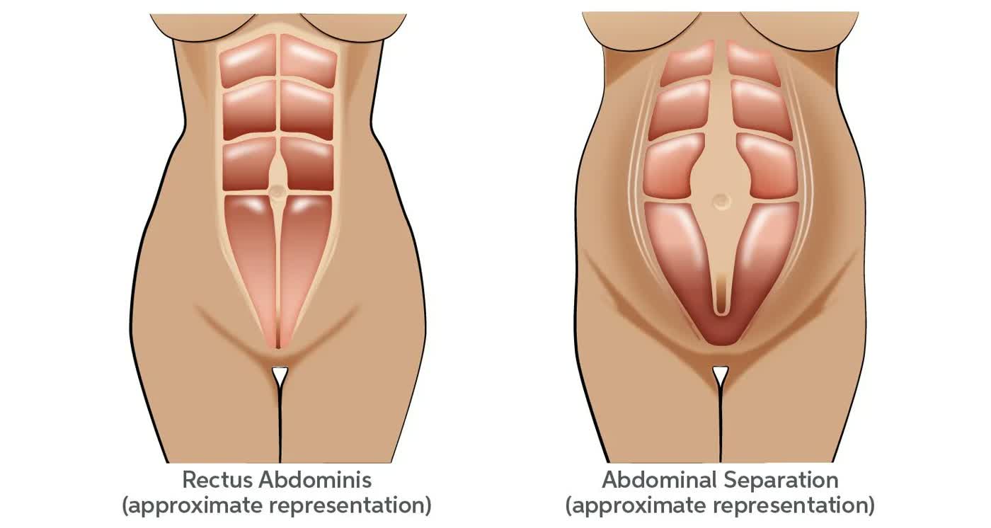 Postpartum recovery: fixing diastasis recti naturally