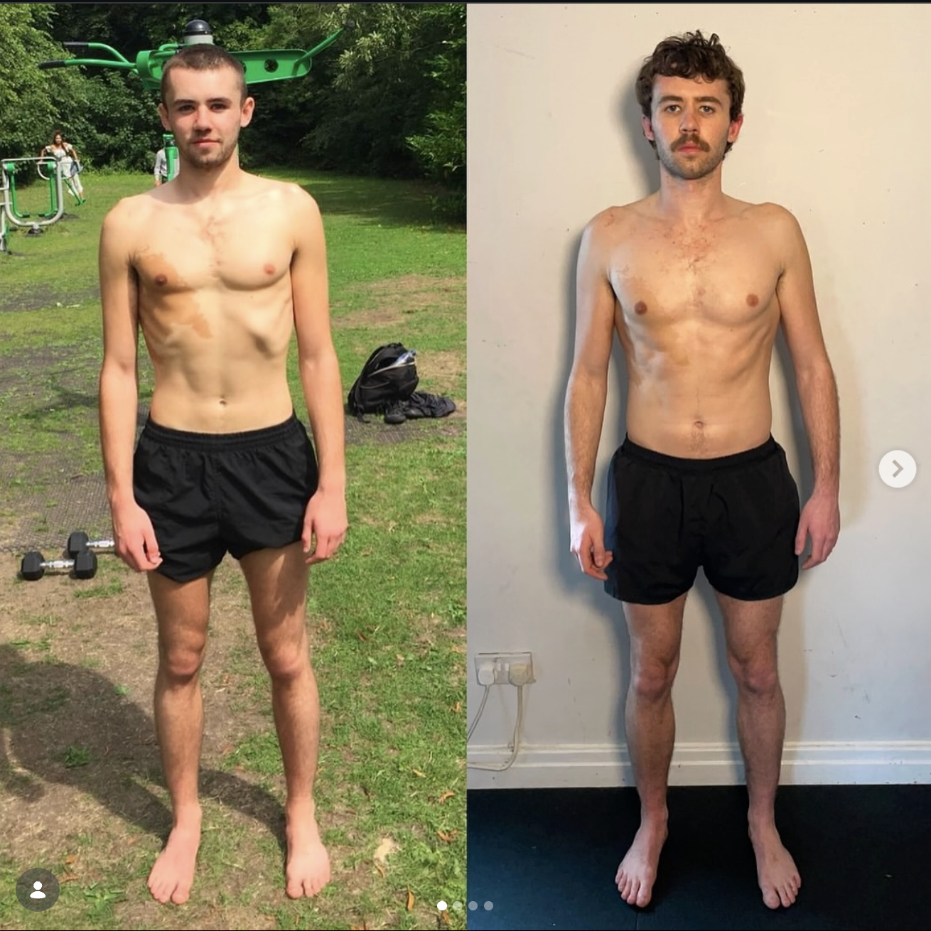 Rib flare correction, before and after