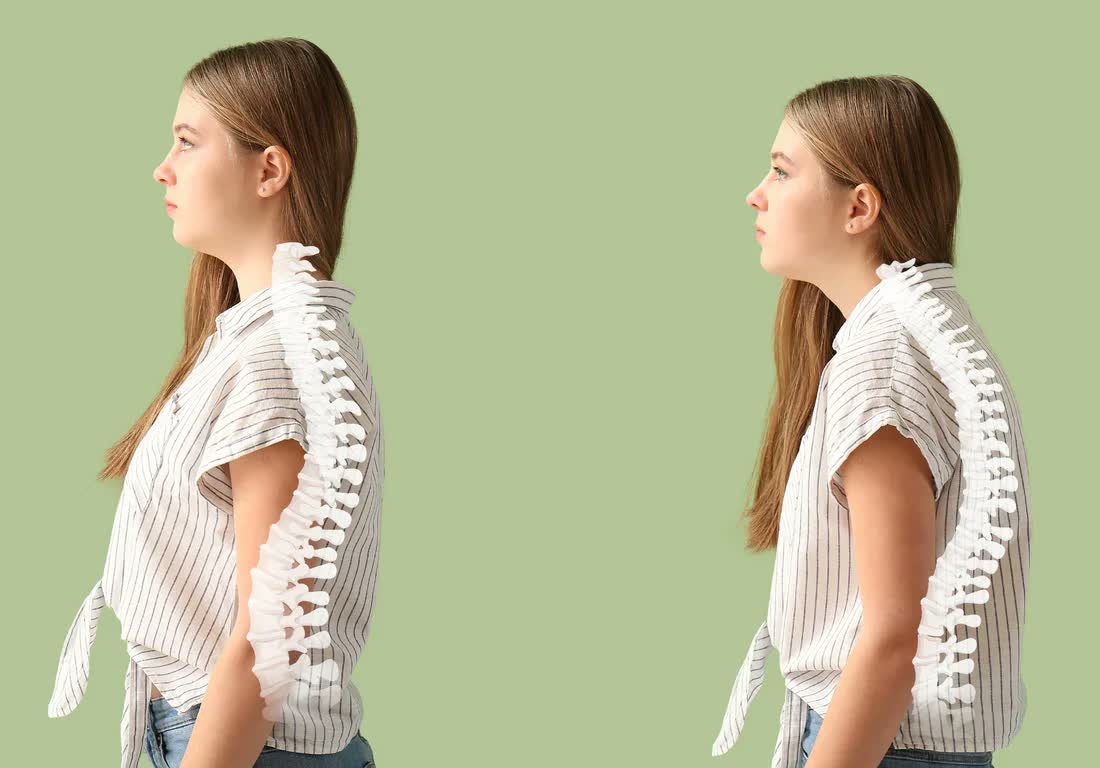 Hunchback posture: fix back pain & build strong structure