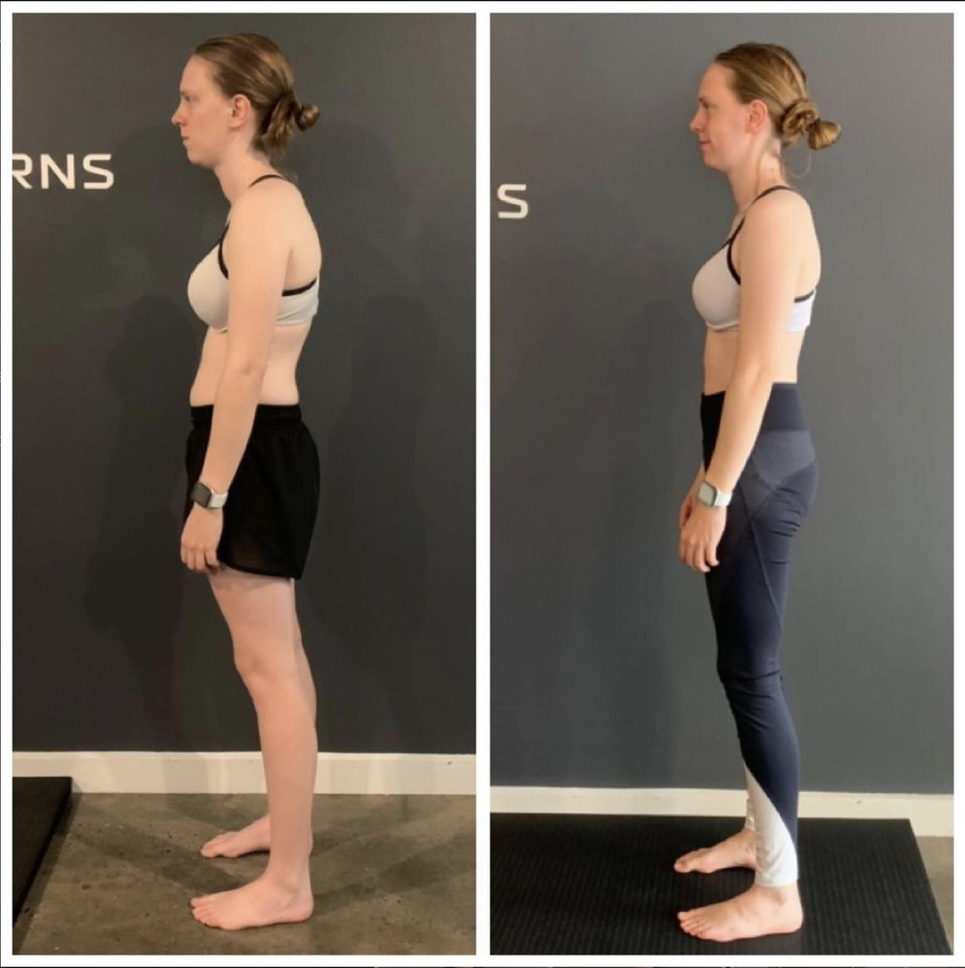 How to fix hyperextended knees naturally