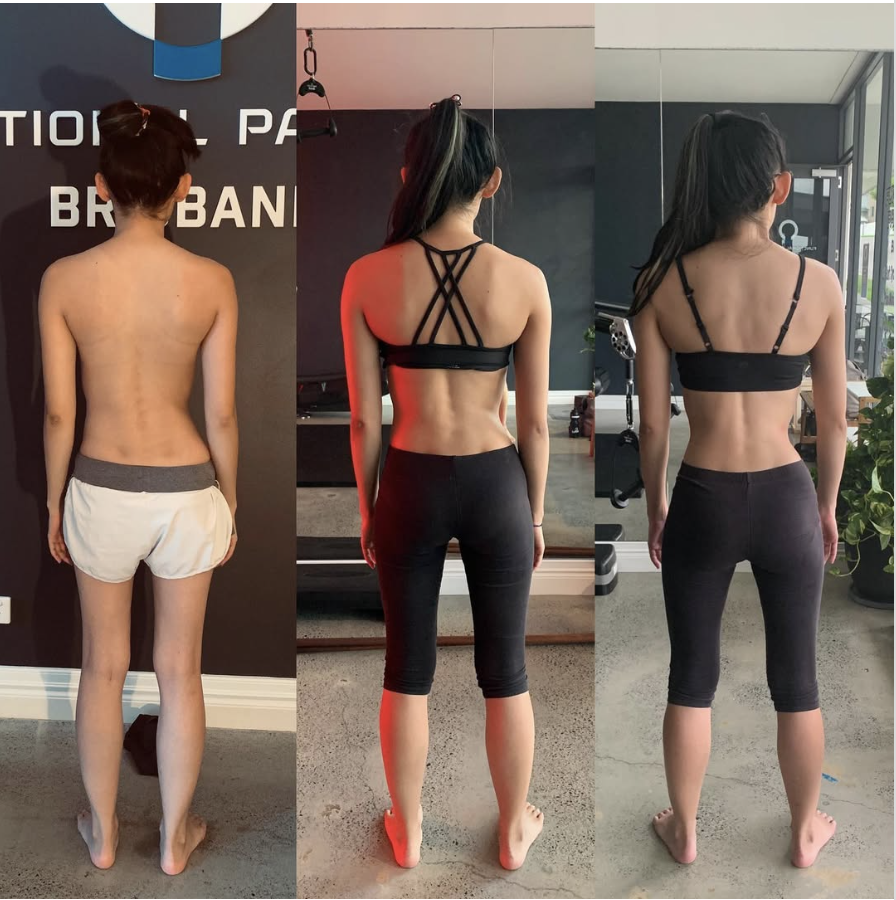 Exploring the link between genetics and scoliosis: is scoliosis hereditary?