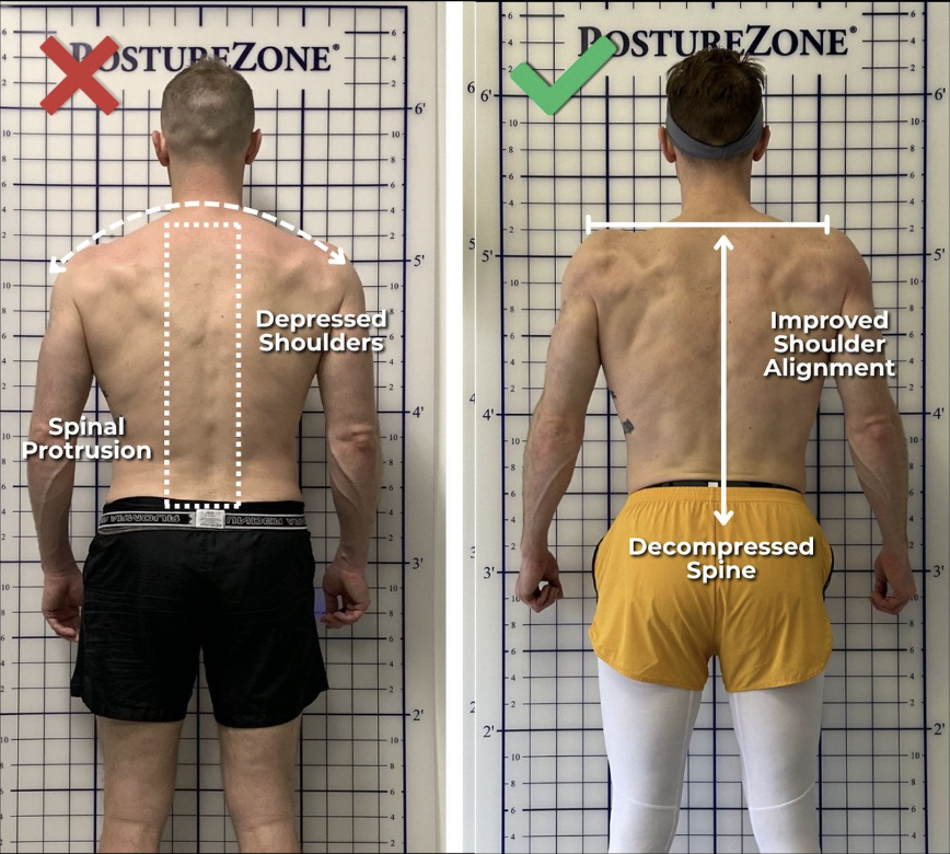 Subscapularis tendinosis explained: understanding the condition beyond the surface