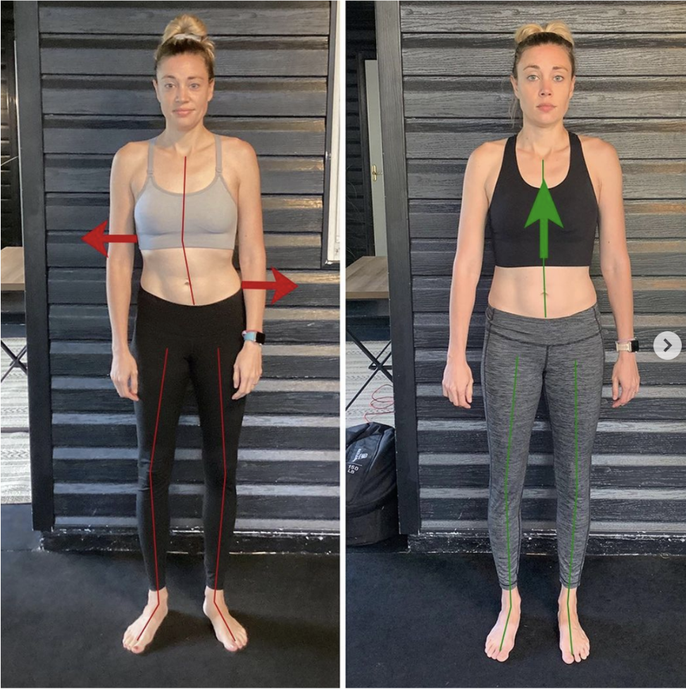 The non-surgical answer to scoliosis